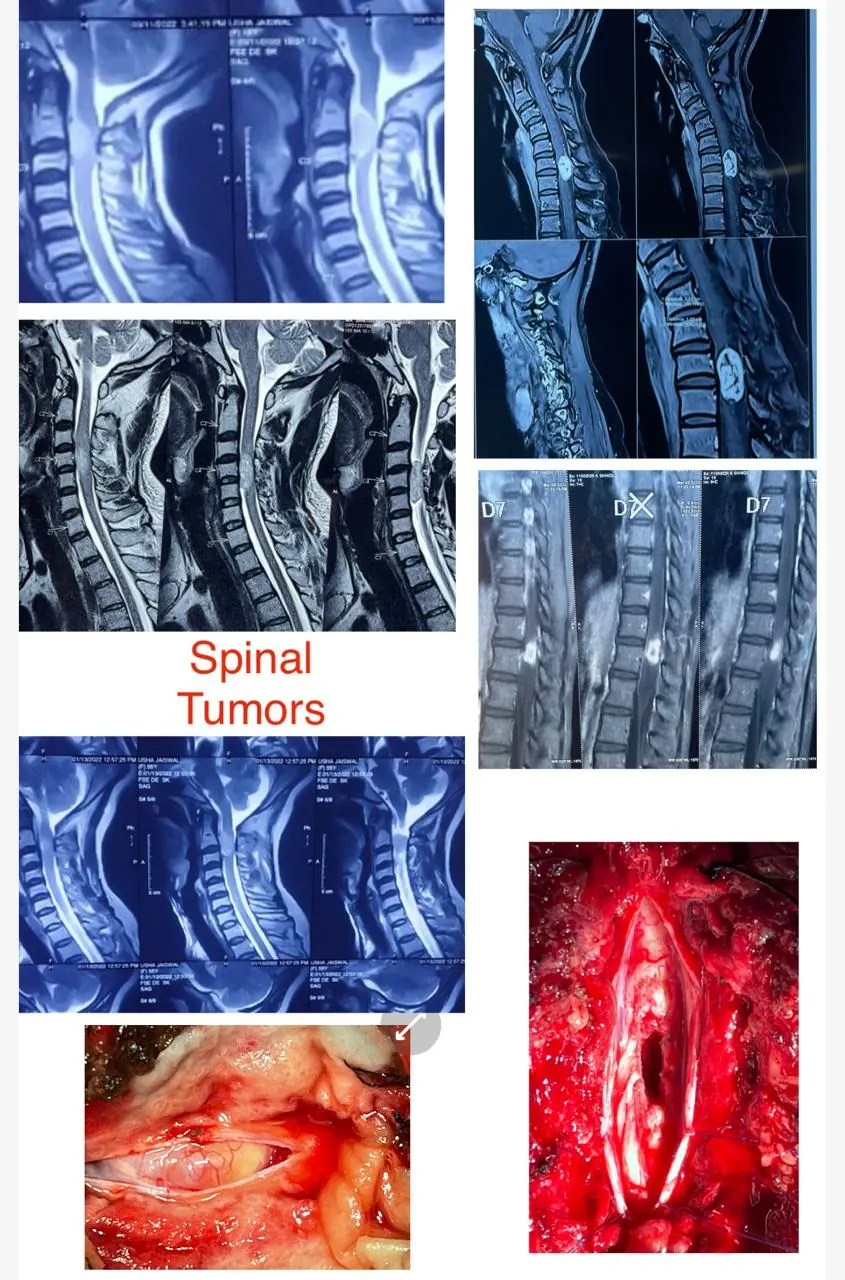 Dr. Abhishek Songara Instagram — Angel Brain & Spine Centre, Indore