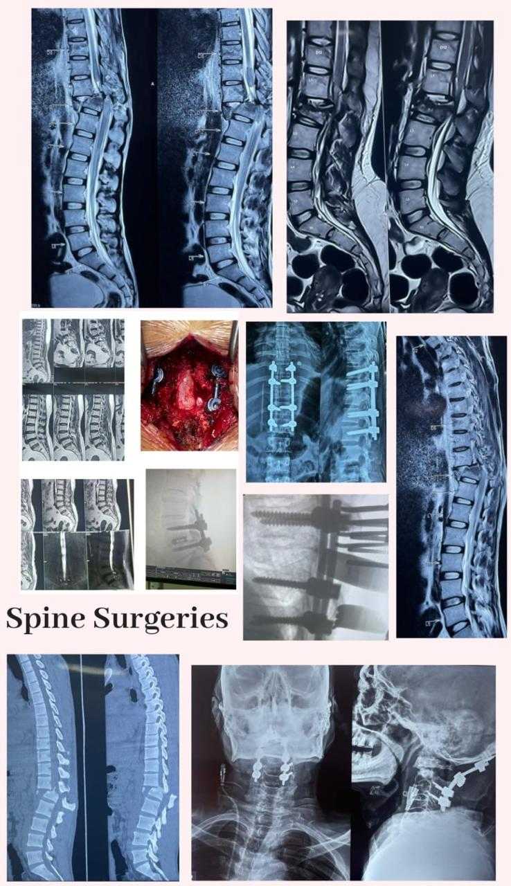 spine surgery in indore, best spine surgeon in indore